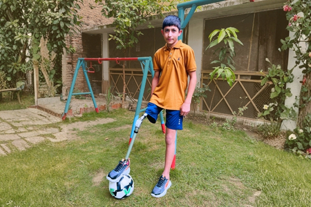 Prosthetic Limbs